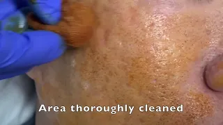 Acne scar Subcision full video