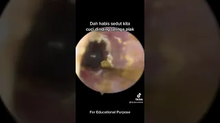 Very Satisfying Earwax Suction