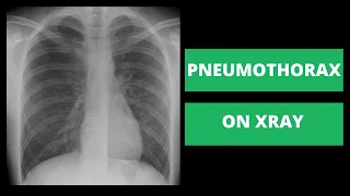 How to Identify a Pneumothorax on Xray - Strategies from a Radiologist