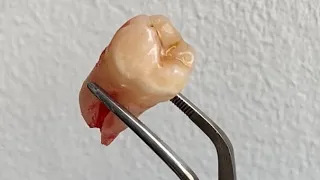 Видалення зубів мудрості / Wisdom tooth extraction 🪚🦷