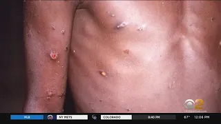 NYC looking into possible case of monkeypox