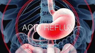 ACID REFLUX