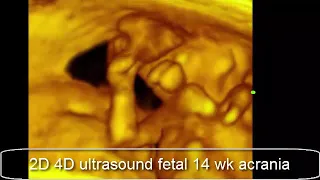 case 673 fetal 14 wk acrania 2D 4D ultrasound