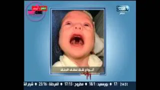 مشاكل الاطفال حديثى الولاده  الشفه و سقف الحلق