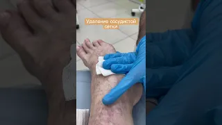 Удаление сосудистой сетки на ногах. Склеротерапия. Флеболог Москва
