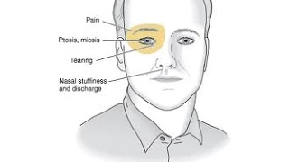 Cluster Headache