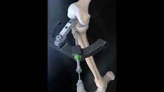 Интрамедуллярный остеосинтез большеберцовой кости  Іntramedullary osteosynthesis of the tibia