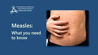 Measles: What You Need to Know