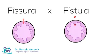 Qual a diferença de fissura e fístula?