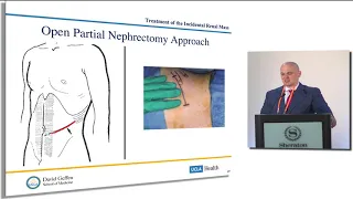 Treatment of the Incidental Renal Mass: What are my options and which one is best?