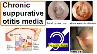 chronic suppurative otitis media