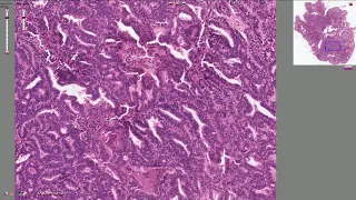 Endometrial Adenocarcinoma - Histopathology