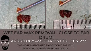 12 DAYS OF WAXMAS - EAR WAX REMOVAL DAY 7 - EP 273