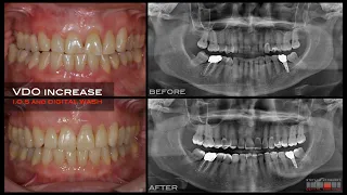 WORN DENTITION, JIG for Deprogrammed Passively Retruded (DPR) Position; Intra Oral Scanner and BOPT