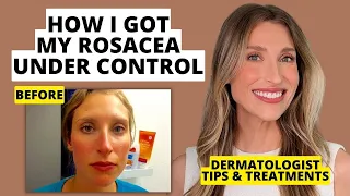 My Rosacea Journey: Dermatologist Shares Skincare & Treatments That Work! | Dr. Sam Ellis