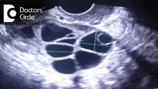 Purpose of Monitoring follicle size during Infertility Treatment - Dr. Ashwini S G