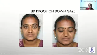 Dr Vidhya N - Evaluation of Eyelid Malposition - Oculoplasty