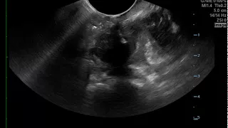 Peritonsillar Abscess Needle Drainage, US  JETem 2017