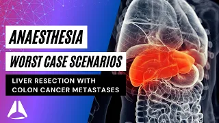 Liver Resection for Colon Cancer Mets | Worst Case Scenarios | #anesthesia #anaesthesia #exam