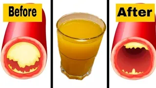 Clean Your Clogged Arteries And Prevent Heart Attack