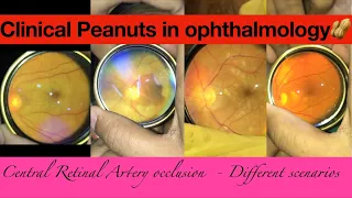 Central Retinal Artery Occlusion variations