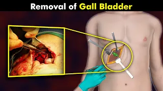 How Cholecystectomy Procedure Is Performed? | Gallbladder Removal Surgery (Urdu/Hindi)