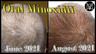 Oral Minoxidil (Loniten) Result in 2 months