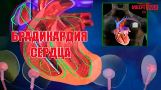 Брадикардия сердца. Как происходит? #сердце #брадикардия #кардиология #кардиолог #медицина #экг