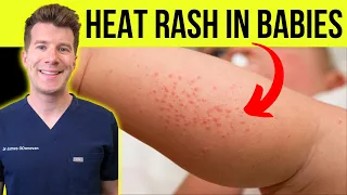 Doctor explains HEAT RASH (miliaria) in a baby | Causes, symptoms, treatment and prevention