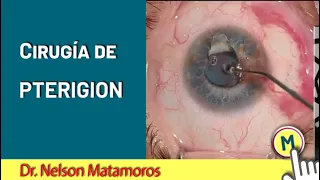 Cirugía de Pterigium con Plastia Libre