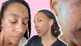 CHEMICAL PEEL PROCESS | Before & After | Hyperpigmentation