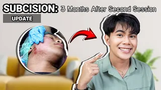 SUBCISION 3 MONTHS AFTER SECOND SESSION | 5 IN 1 SYNERGISTIC ACNE SCAR TREATMENT RESULT