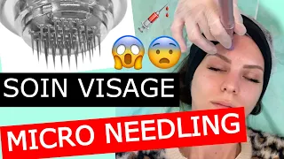 UN SOIN VISAGE AVEC DES AIGUILLES 😨 JE TESTE LE MICRONEEDLING (AVIS ET EXPLICATIONS)