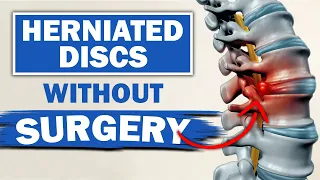 Should I Have Surgery For A Disc Herniation? Pros & Cons