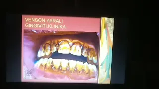 Parodont kasalliklari  Gingivitlar