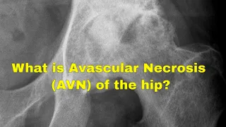 What causes avascular necrosis of the hip (AVN)?
