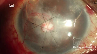 Tenon's Patch Grafting for Difficult Corneal Perforations