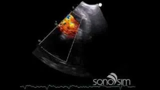 SonoSim Ultrasound Challenge: SonoSim Ultrasound Challenge - Echocardiography