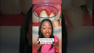 3 signs that YOU have gum disease #shorts #gumdisease #teeth