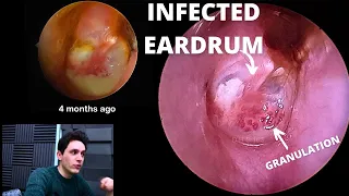 Chronically Infected Eardrum (Granular Myringitis)