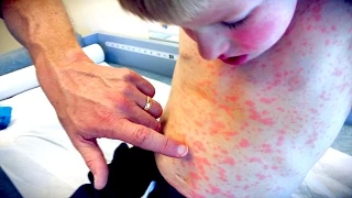 IMPRESSIVE FULL BODY RASH! | Live Diagnosis With Dr. Paul