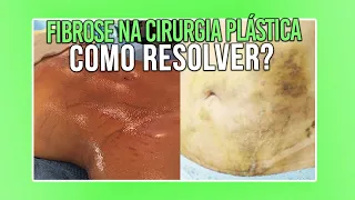 5 COISAS QUE VOCE PRECISA SABER PARA NAO TER FIBROSE NA CIRURGIA PLÁSTICA