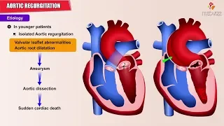 Aortic regurgitation / Aortic insufficiency : Etiology , Pathology , Diagnosis  and Treatment- USMLE