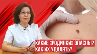 Какие родинки нужно удалять и как?