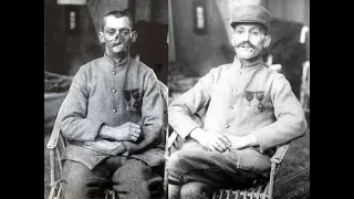 Before & After Photos Of First World War Veterans Who Were Helped By A Pioneering Plastic Surgeon