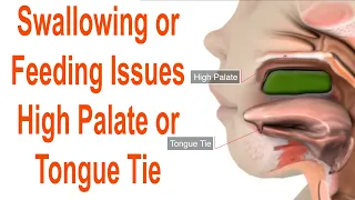 Feeding Or Swallowing Problems Due to High Plate or Tongue Tie