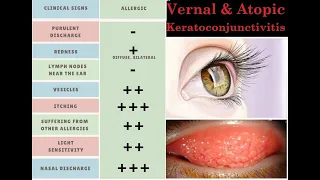 Vernal & Atopic keratoconjunctivitis #kanskiseries #2022