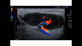 Ultrasound of a benign inflamed lymph node