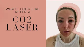 My CO2 Laser Experience: Post-Treatment Transformation and Recovery Tips by an Expert Dermatologist