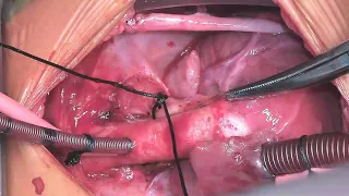 Osman Al-Radi: Arterial switch with intramural left main coronary